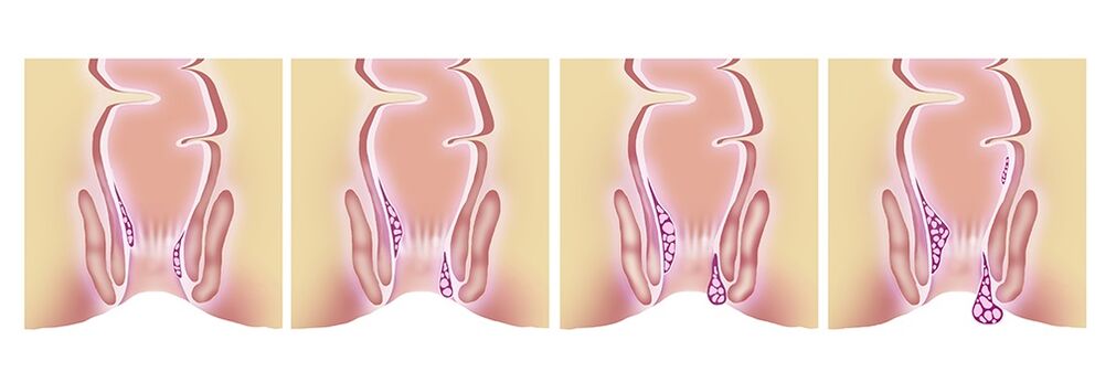 Gelarex effective in all phases